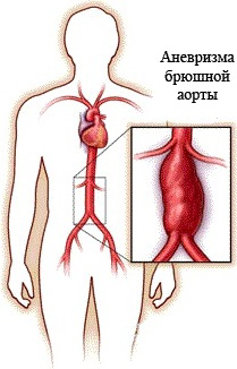 Разрыв аорты симптомы у мужчин. Аневризмы брюшного отдела аорты. Атеросклероз брюшного отдела аорты. Аневризма брюшного отдела аорты симптомы. Веретенообразная аневризма брюшной аорты.