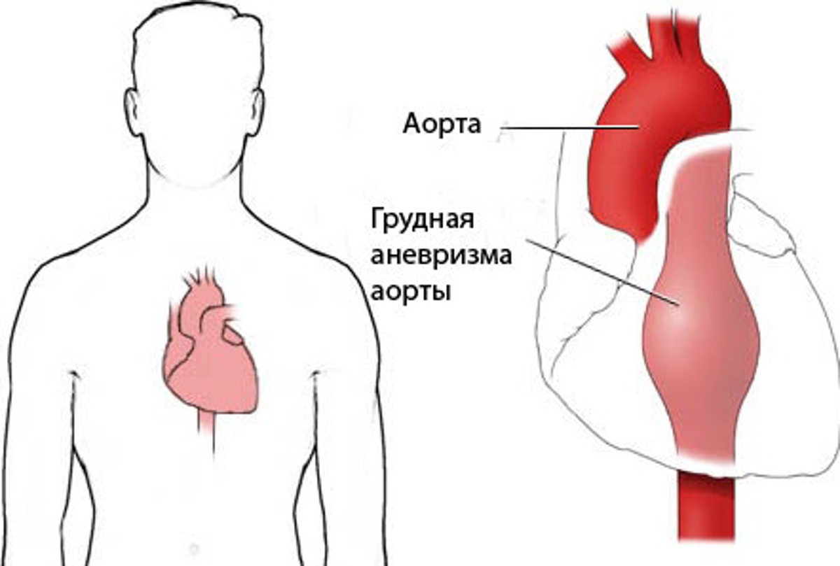 Разрыв аорты симптомы у мужчин. Аневризм аорты грудного отдела что это. Атеросклероз брюшного отдела аорты. Аневризма грудной аорты. Разрыв аневризмы грудной аорты.