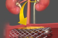 Ангиопластика и стентирование почечных артерий 