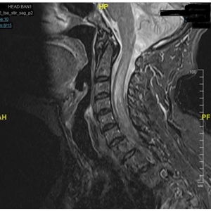 Восстановление ходьбы после операции удаления опухоли шейного отдела спинного мозга