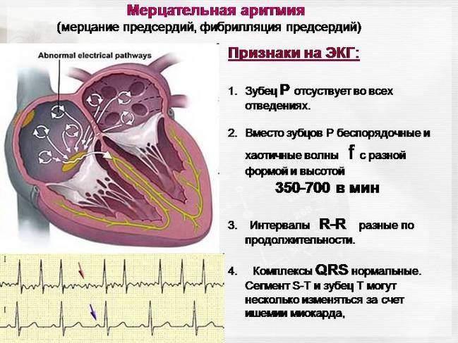 Мерцательная Аритмия Сердца На Экг Фото