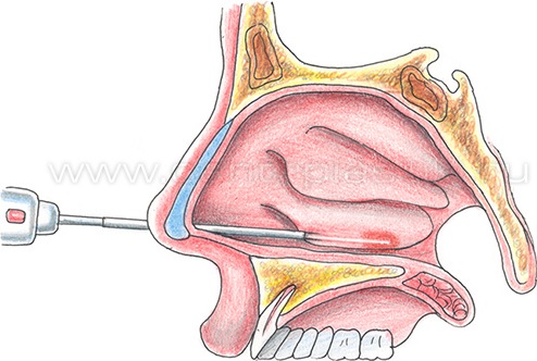 Вазотомия Нижних Носовых Раковин Цена Москва