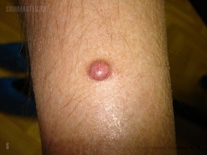 Dermatofibroma hotsell