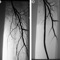 Ангиопластика и стентирование бедренных артерий 